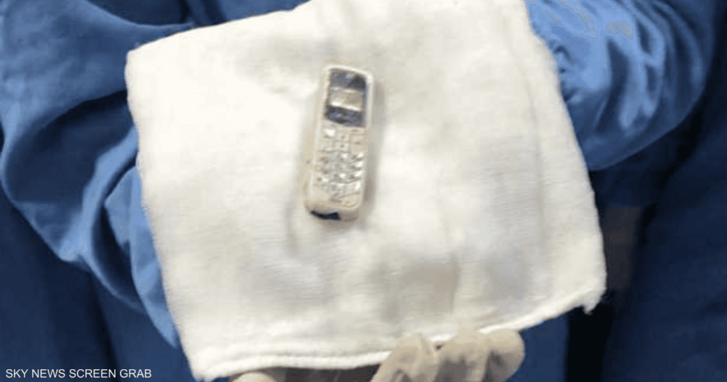 ابتلعه قبل سنوات.. طبيبة مصرية تستخرج هاتفا من معدة سجين